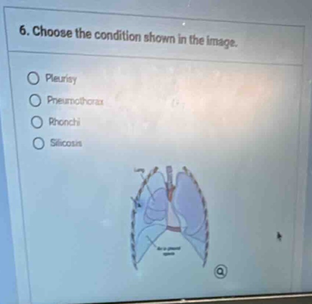 6. choose the condition shown in the image. pleurisy pneumothorax rhonc…