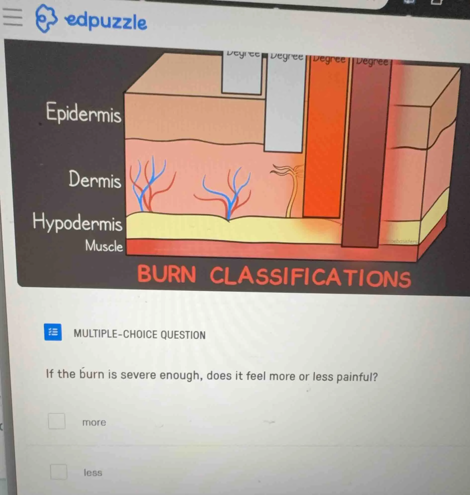 multiple-choice question if the burn is severe enough, does it feel mor…