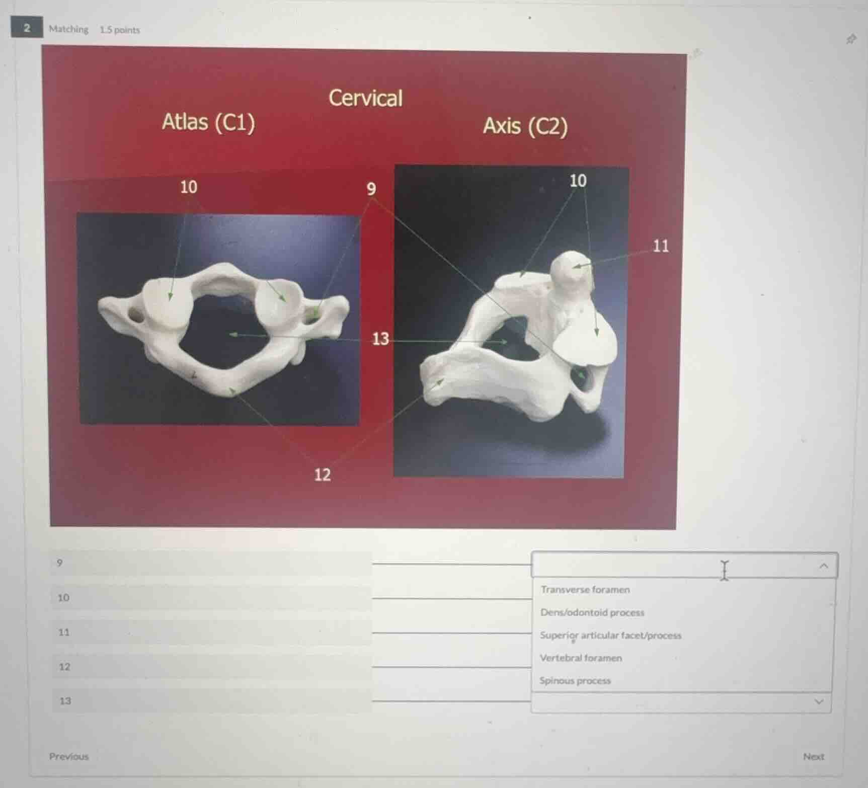 cervical atlas (c1) axis (c2) 10 9 10 11 13 12 9 10 11 12 13 transverse…