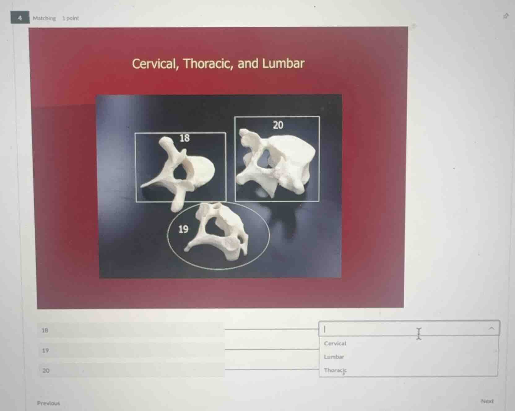 matching 1 point cervical, thoracic, and lumbar 18 19 20 cervical lumba…
