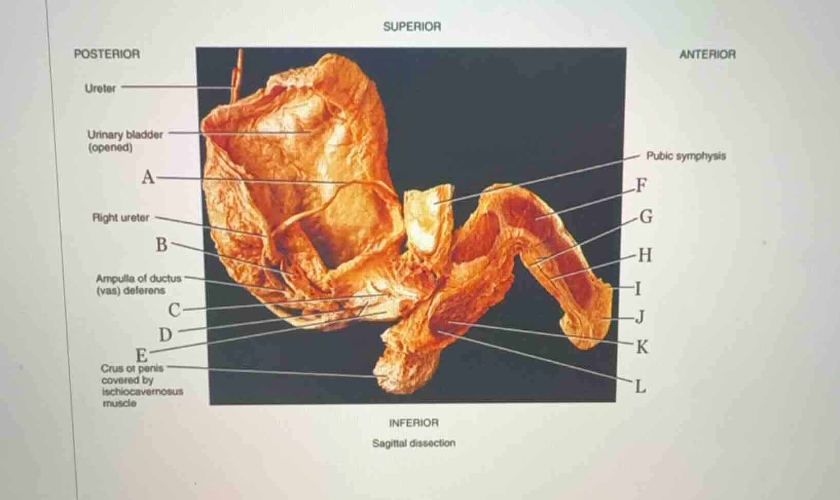 superior posterior anterior ureter urinary bladder (opened) pubic symph…