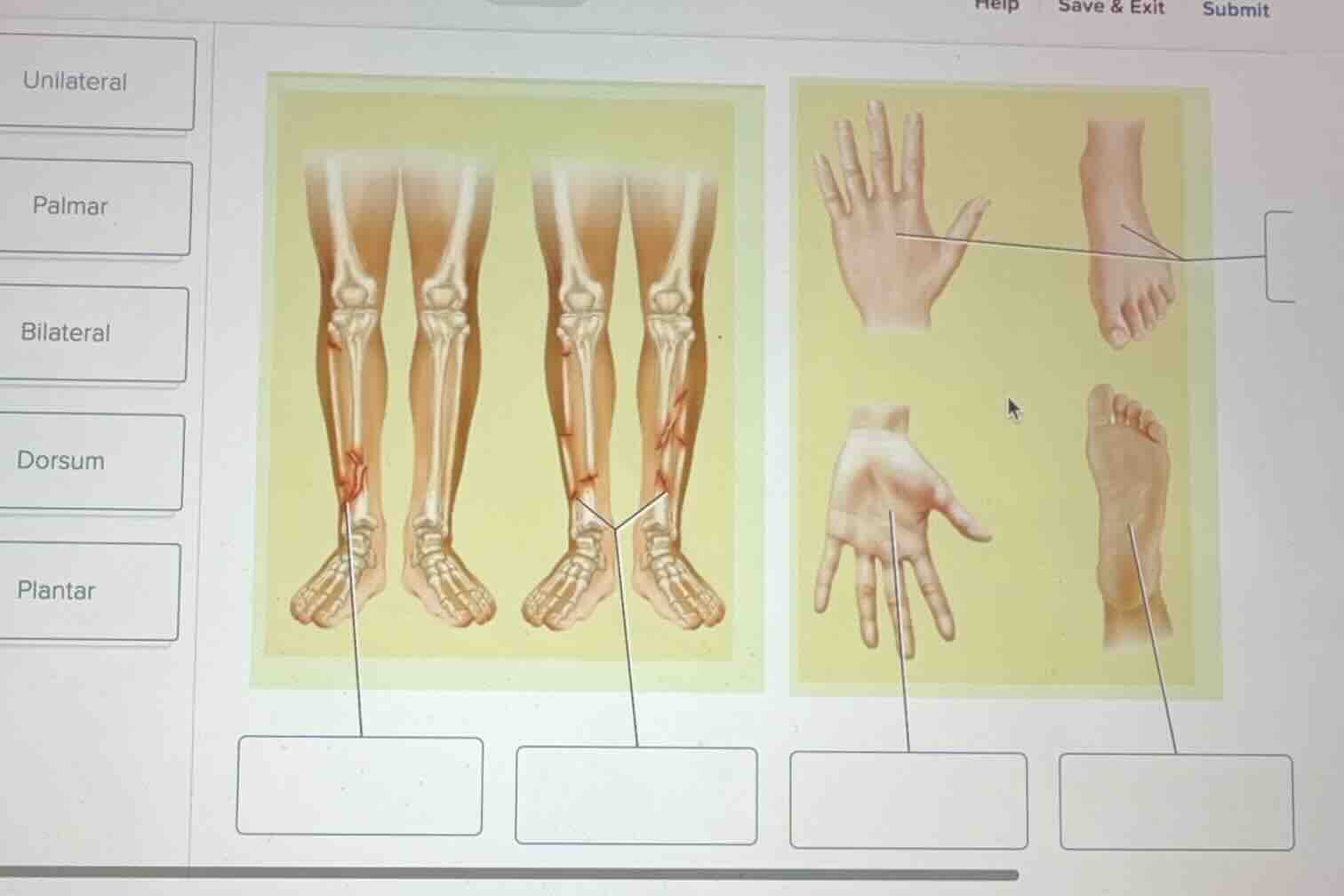 unilateral palmar bilateral dorsum plantar