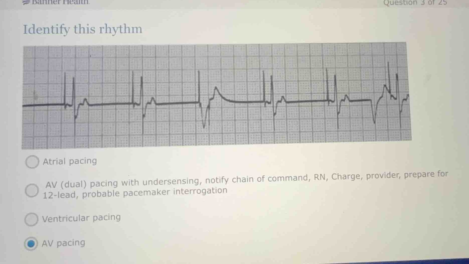 identify this rhythm atrial pacing av (dual) pacing with undersensing, …