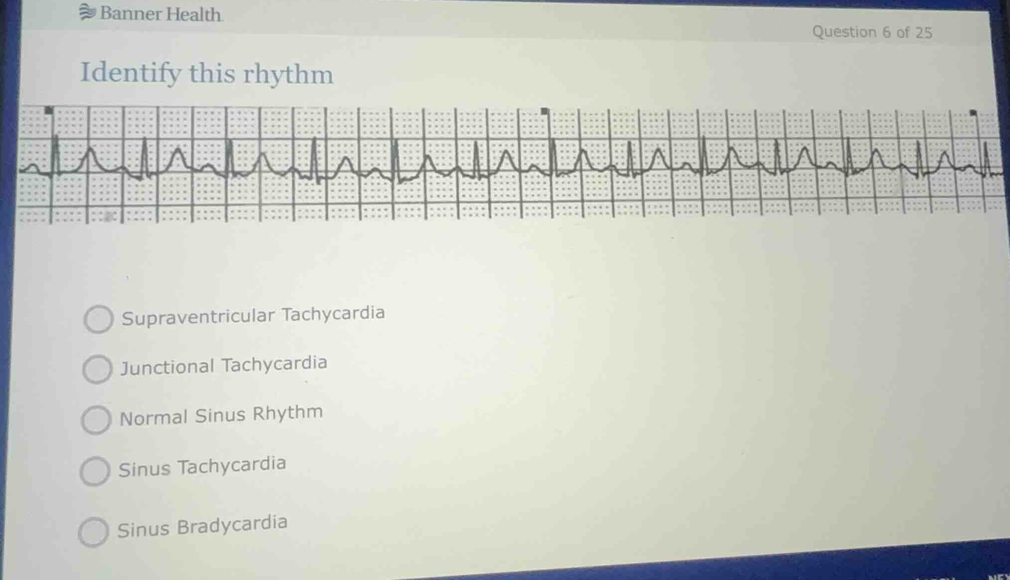 identify this rhythm supraventricular tachycardia junctional tachycardi…