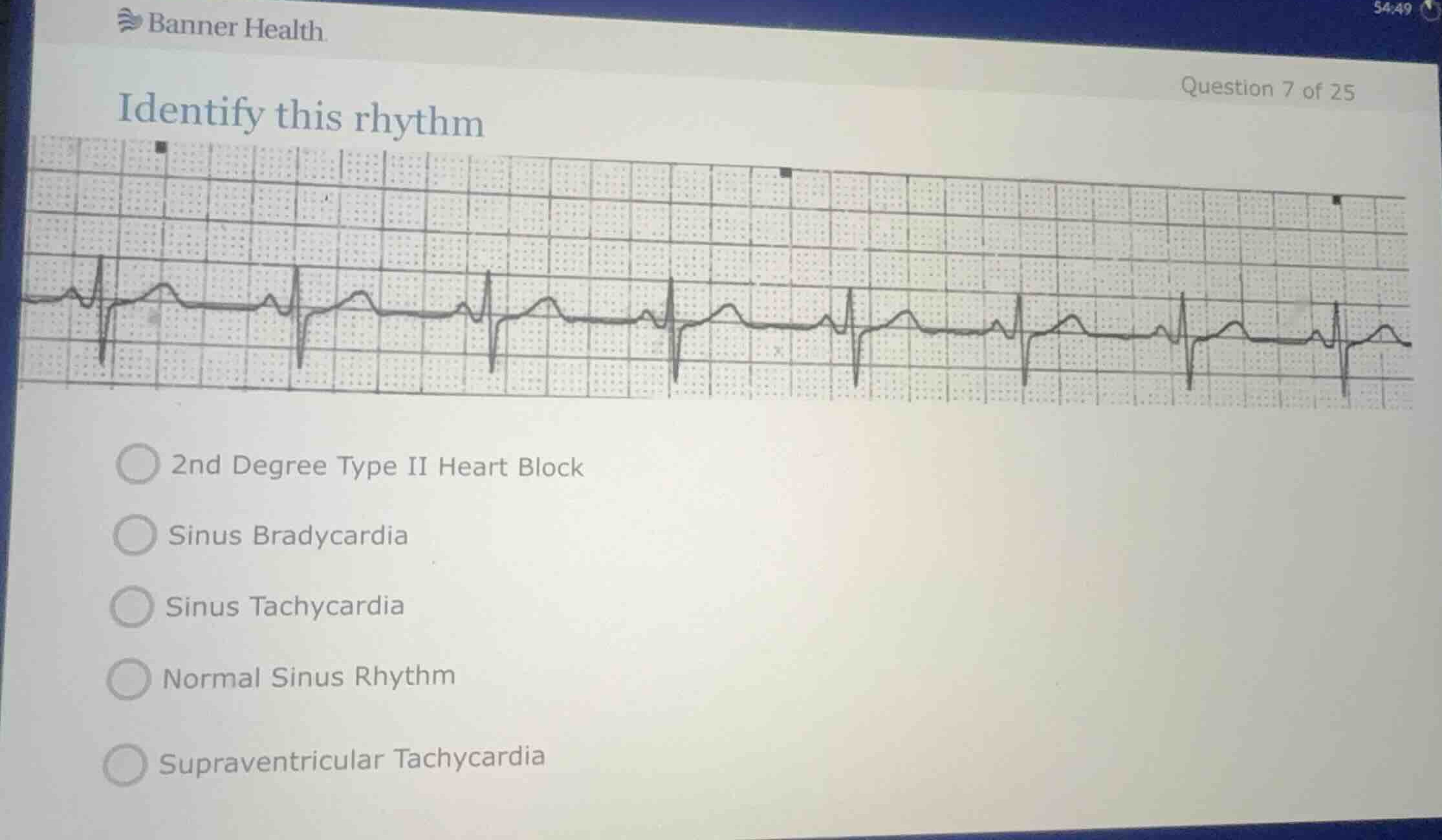 identify this rhythm 2nd degree type ii heart block sinus bradycardia s…