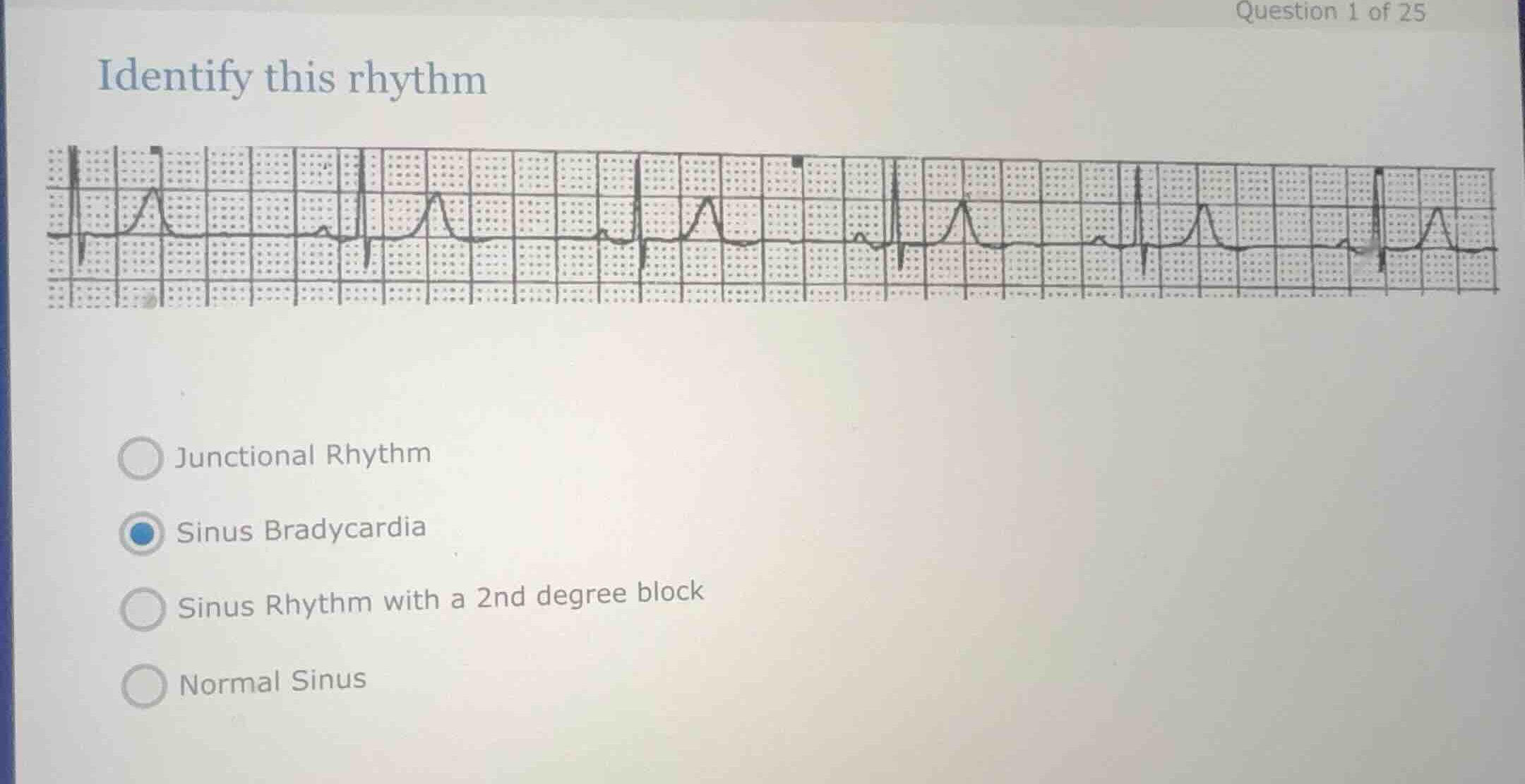 identify this rhythm junctional rhythm sinus bradycardia sinus rhythm w…