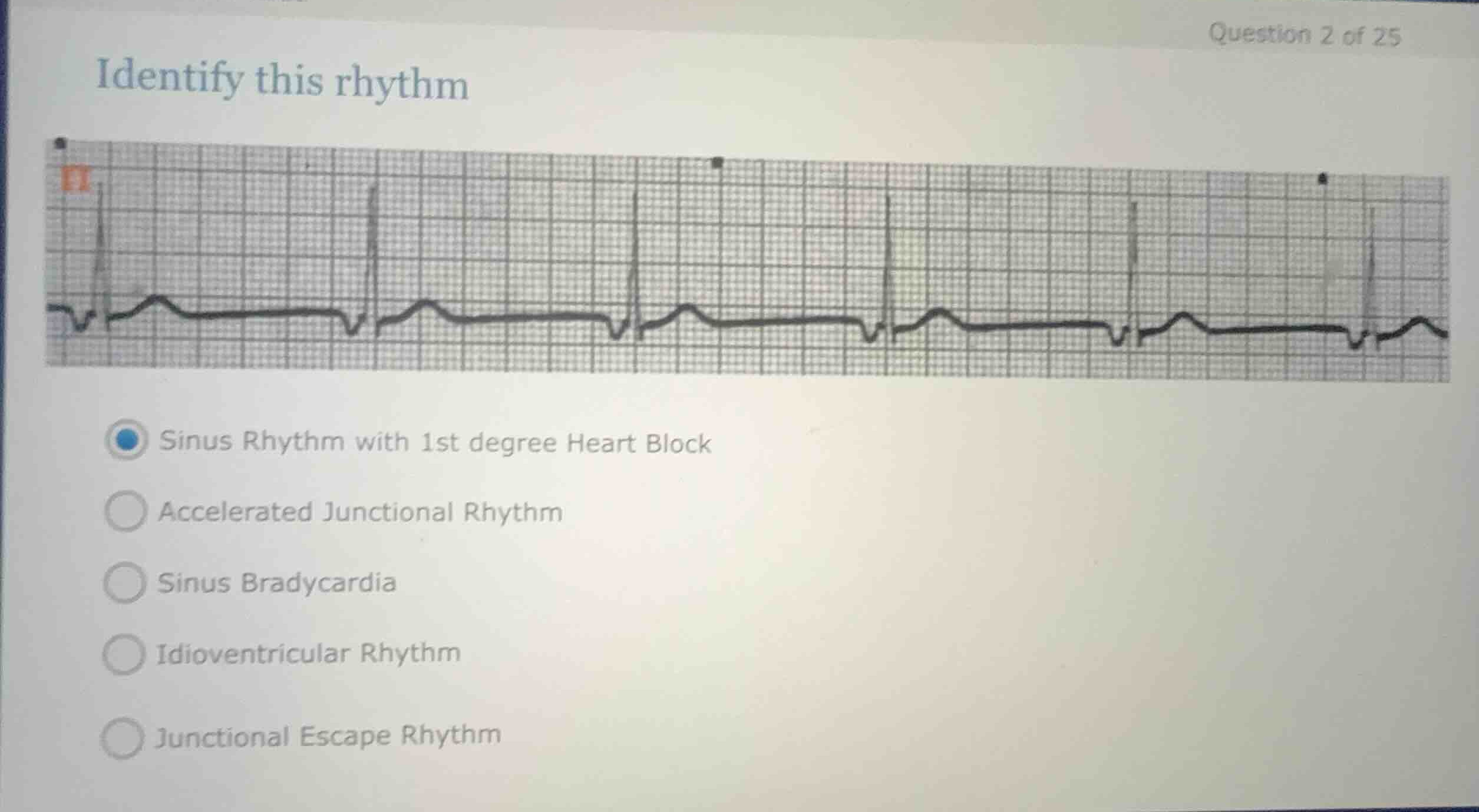 identify this rhythm sinus rhythm with 1st degree heart block accelerat…