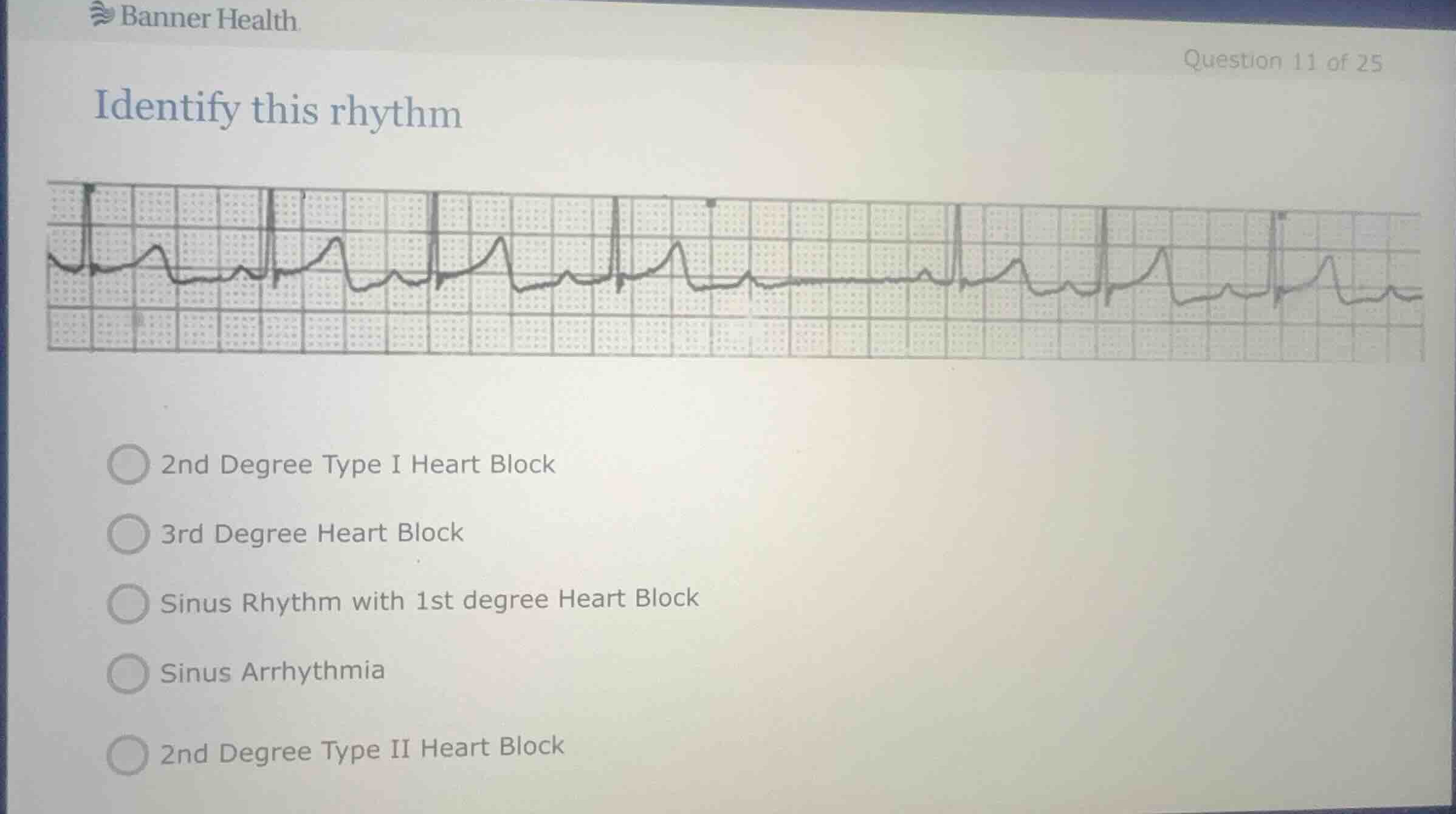 identify this rhythm 2nd degree type i heart block 3rd degree heart blo…