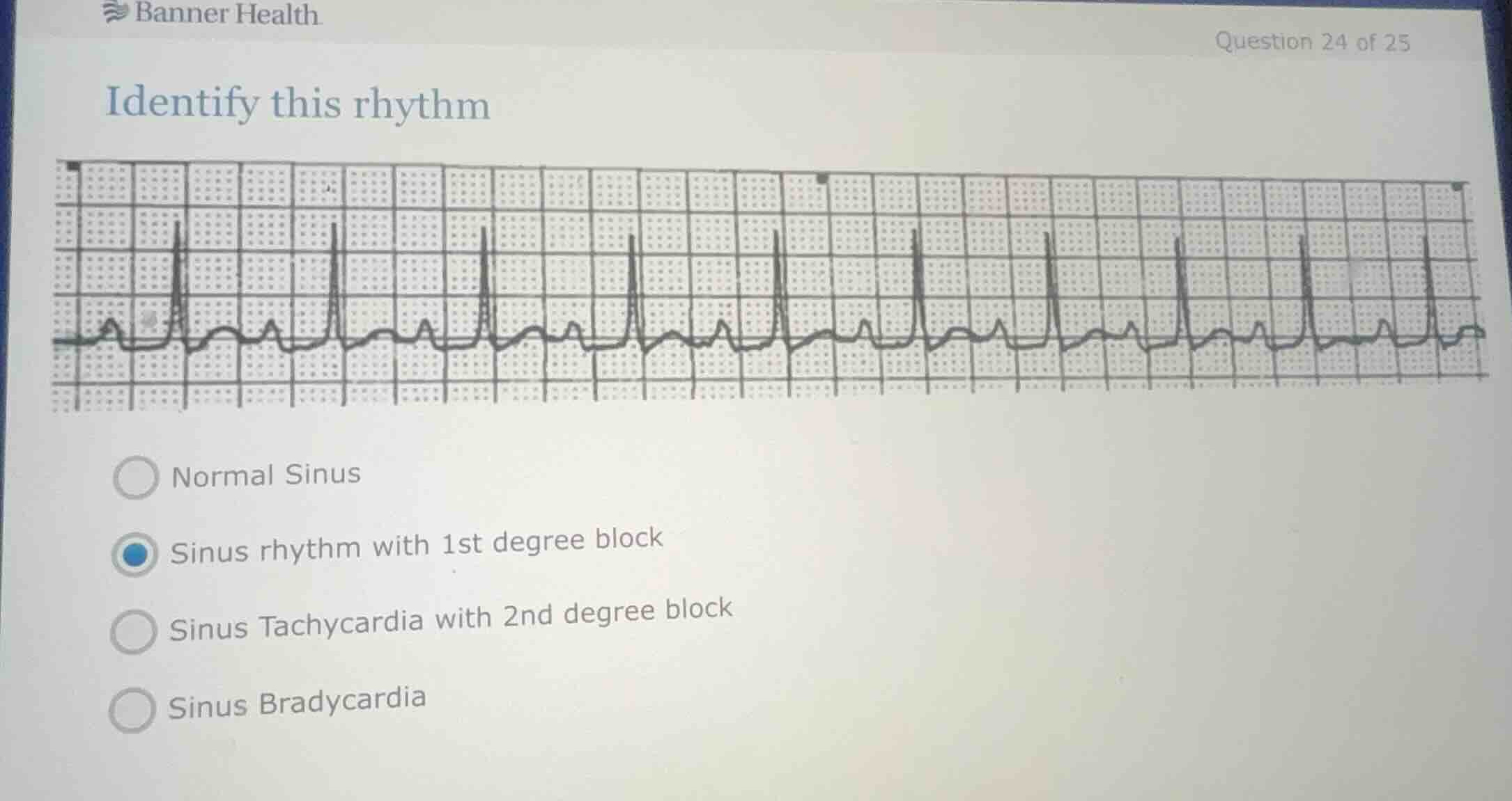 identify this rhythm normal sinus sinus rhythm with 1st degree block si…