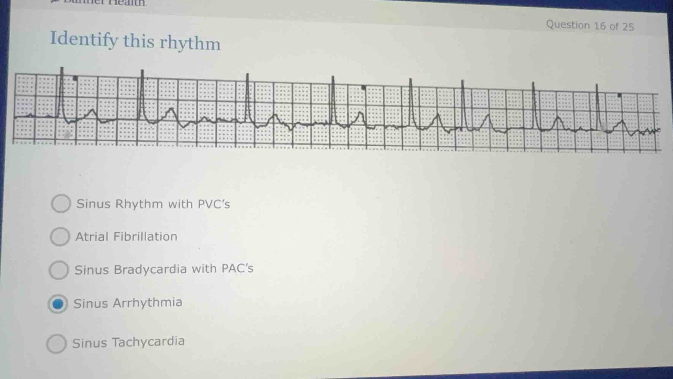 identify this rhythm sinus rhythm with pvcs atrial fibrillation sinus b…