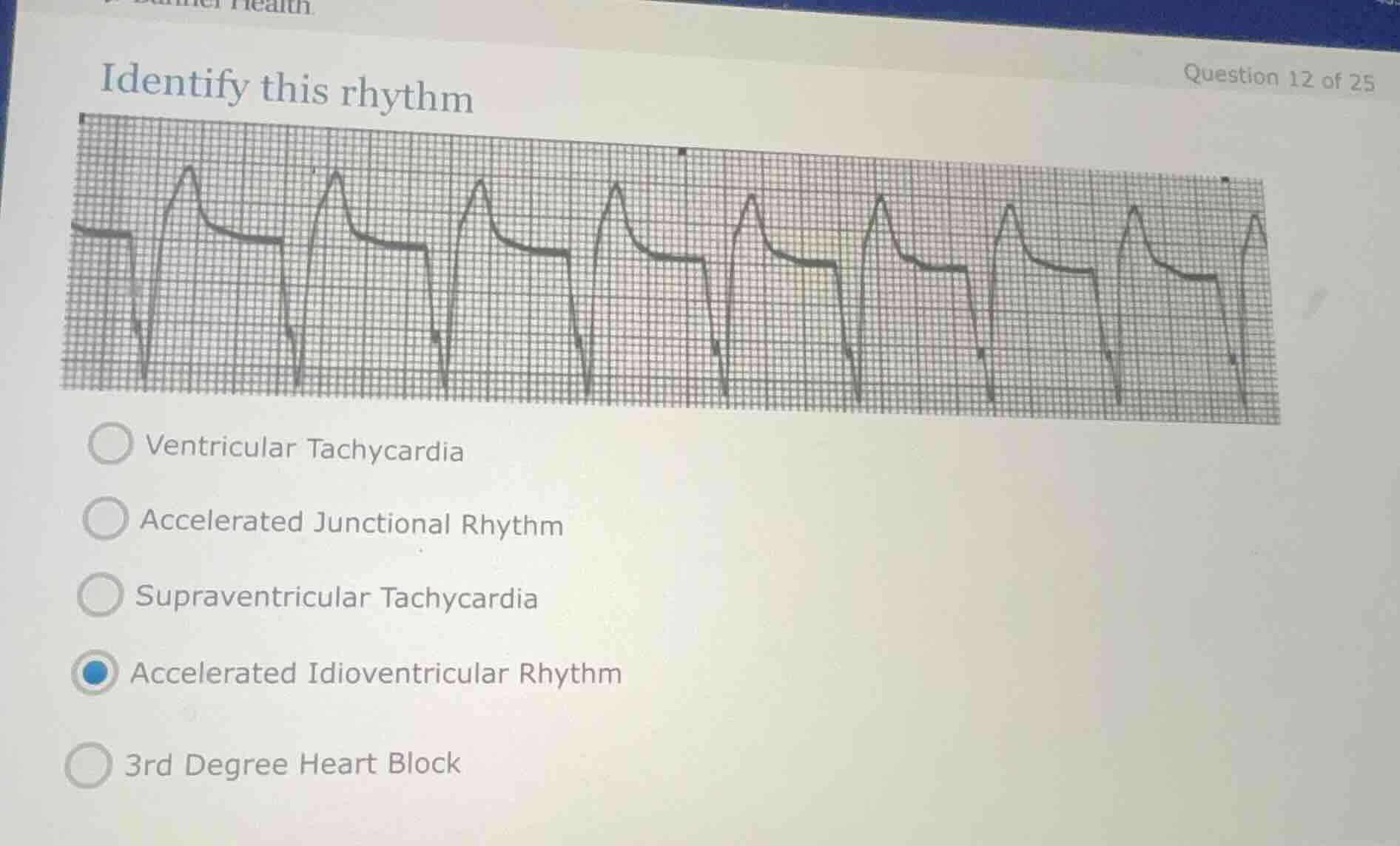 identify this rhythm ventricular tachycardia accelerated junctional rhy…