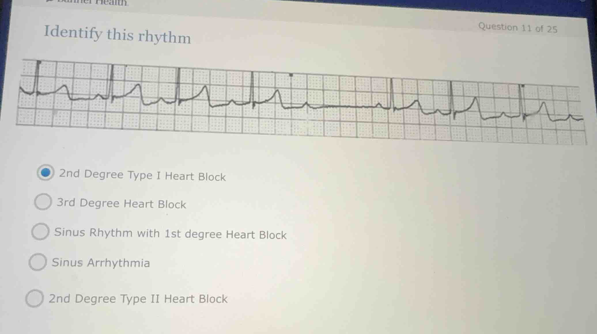 identify this rhythm 2nd degree type i heart block 3rd degree heart blo…