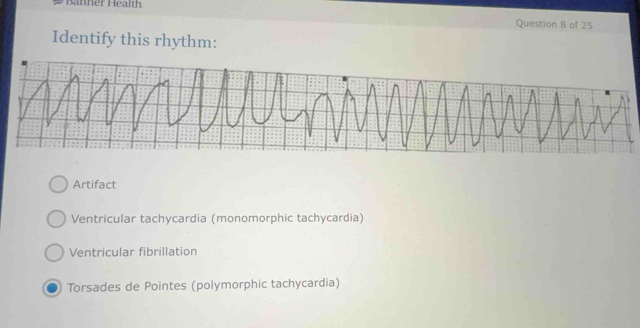 identify this rhythm: artifact ventricular tachycardia (monomorphic tac…
