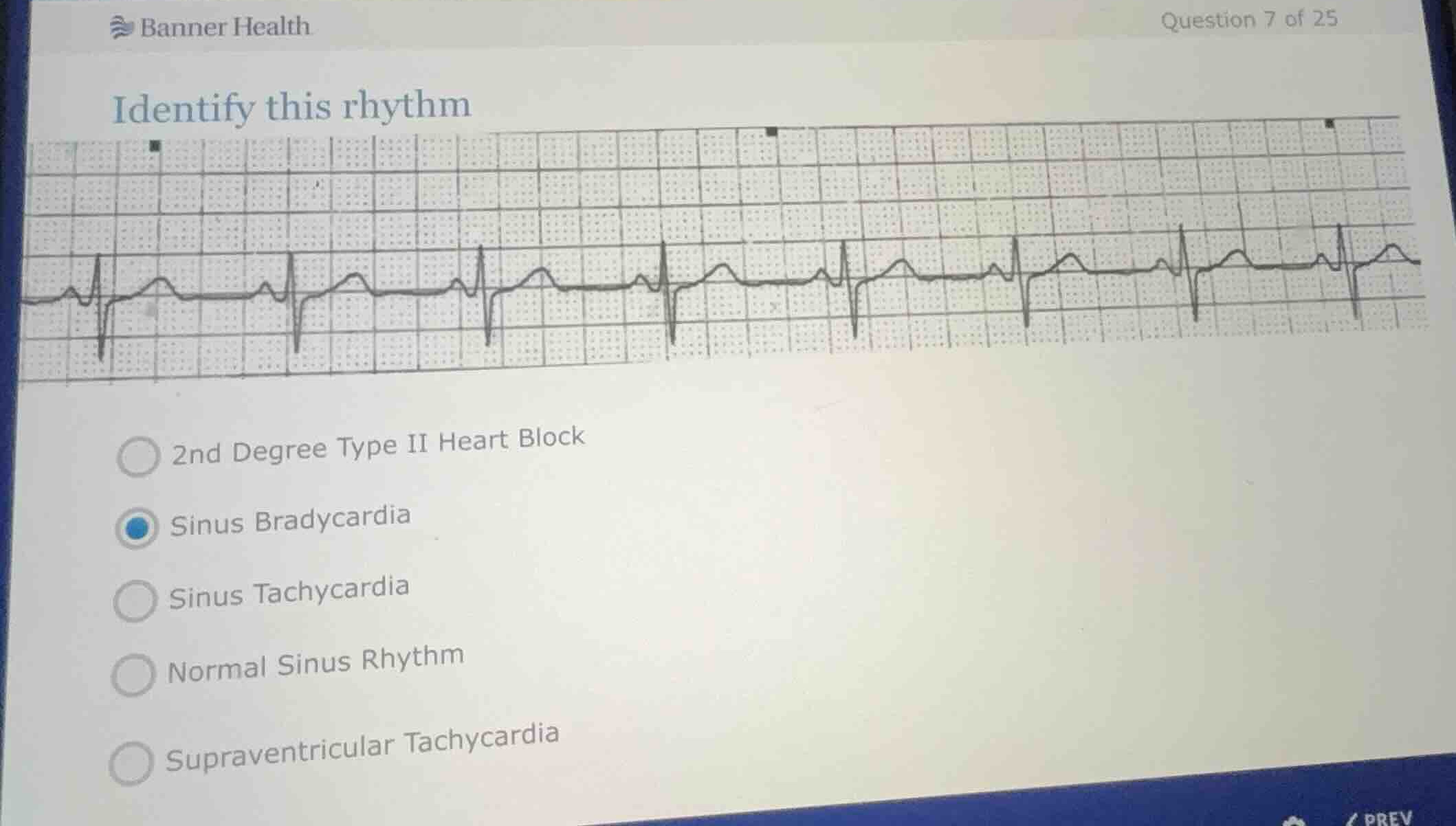 identify this rhythm 2nd degree type ii heart block sinus bradycardia s…