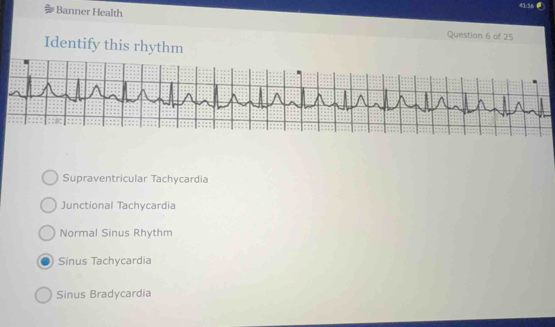 identify this rhythm supraventricular tachycardia junctional tachycardi…