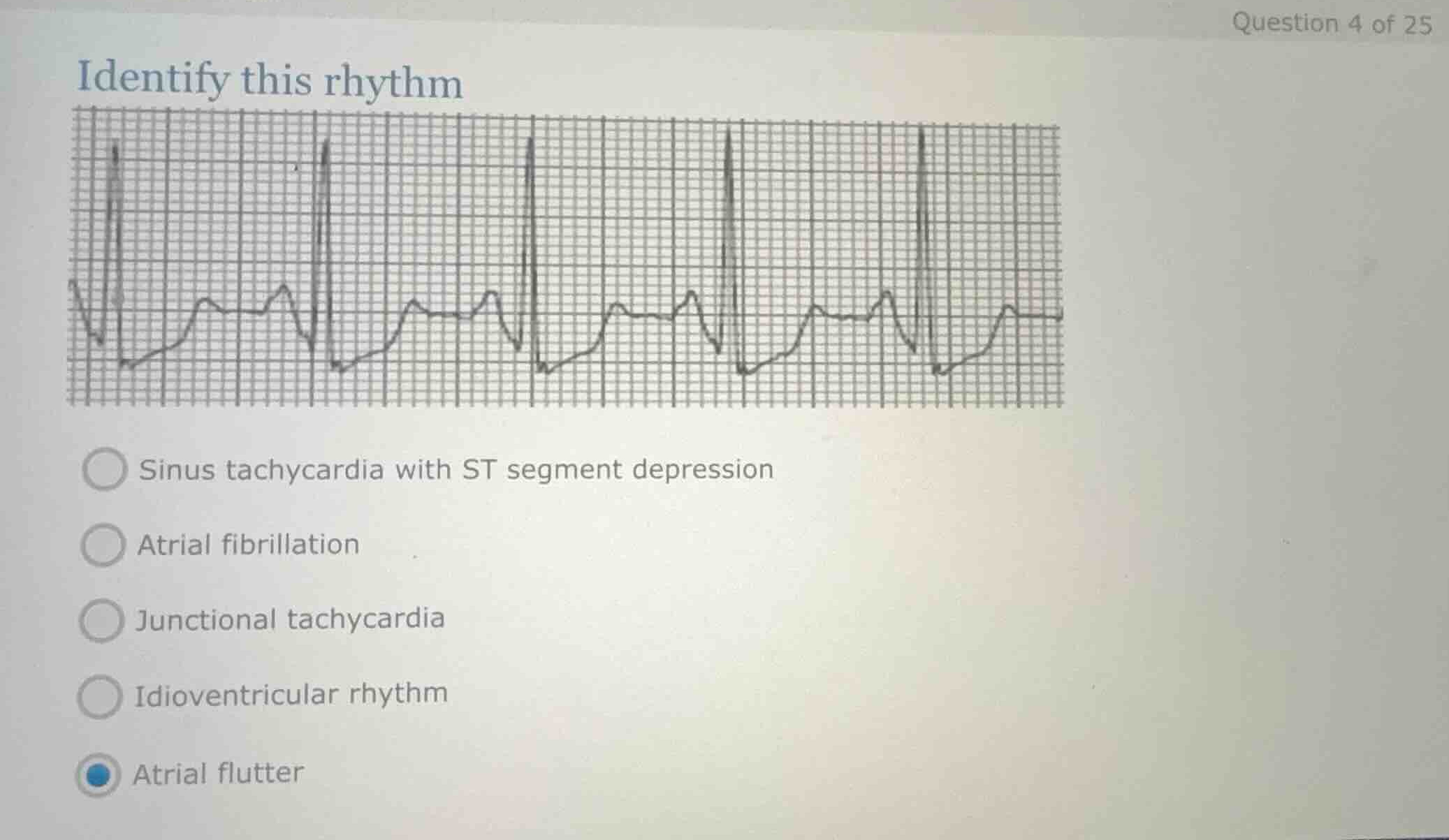 identify this rhythm sinus tachycardia with st segment depression atria…