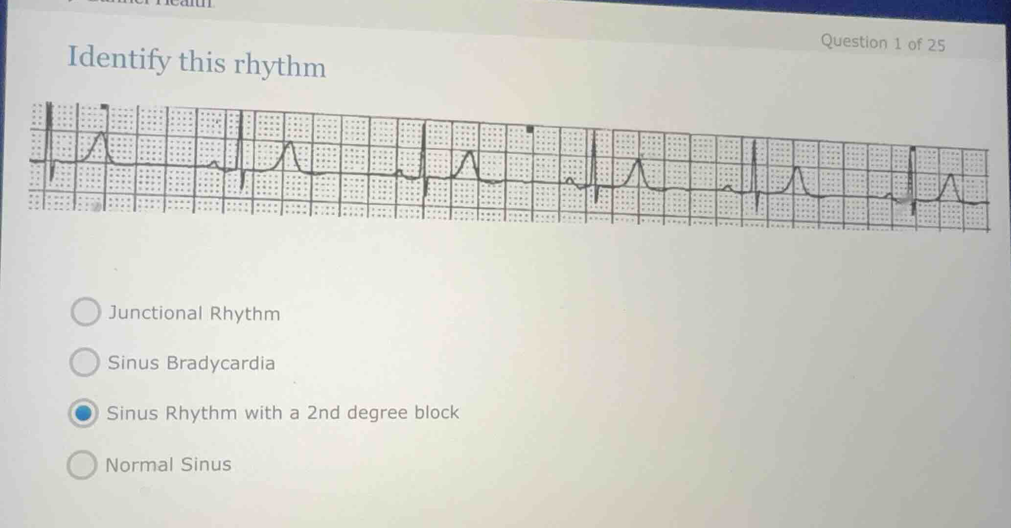 identify this rhythm question 1 of 25 junctional rhythm sinus bradycard…