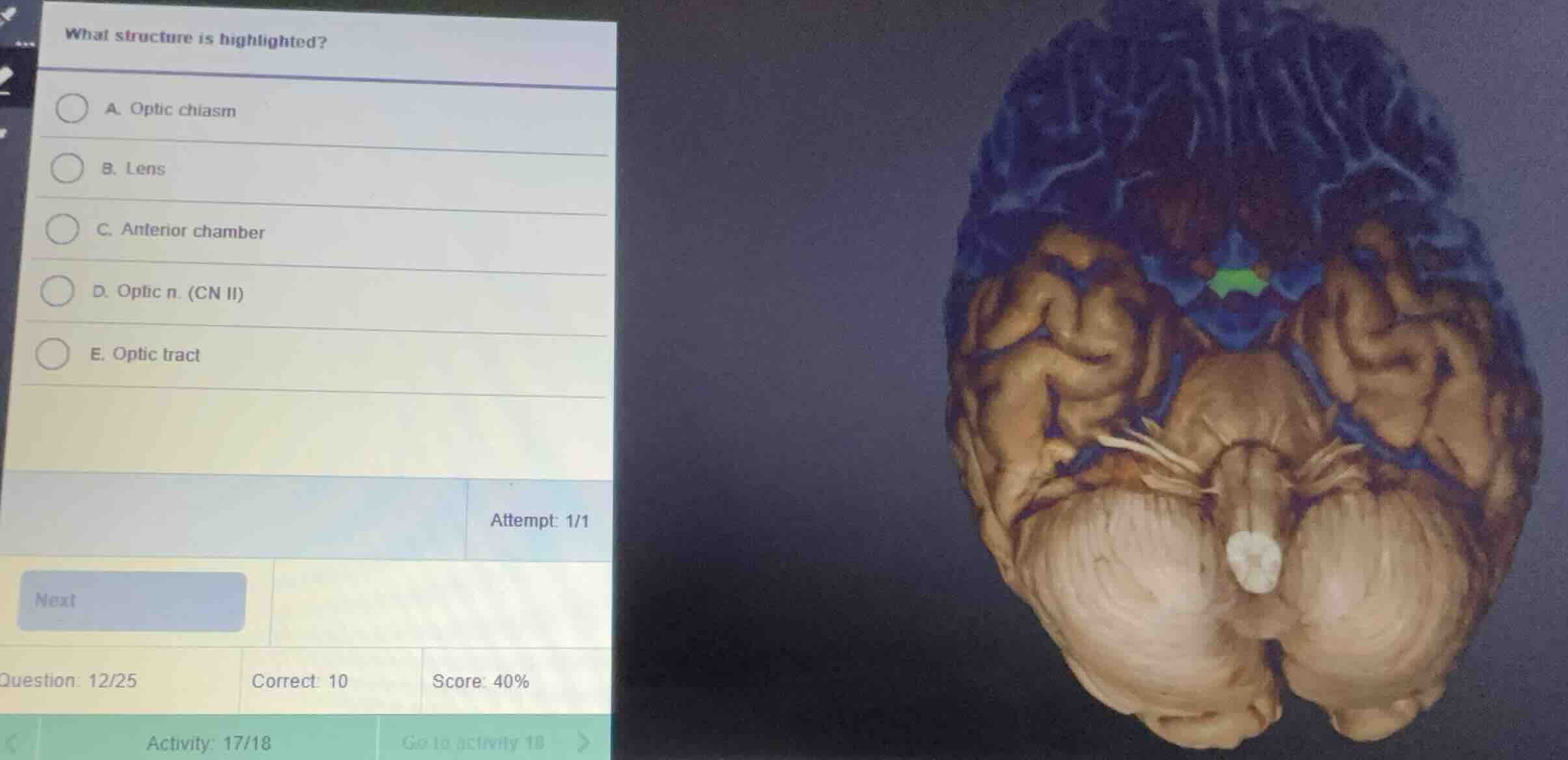 what structure is highlighted? a. optic chiasm b. lens c. anterior cham…