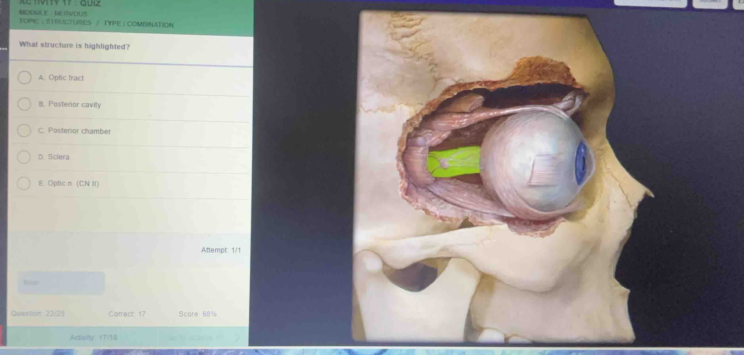 what structure is highlighted? a. optic tract b. posterior cavity c. po…