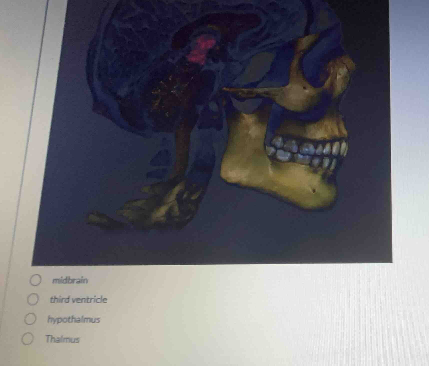 midbrain third ventricle hypothalmus thalmus