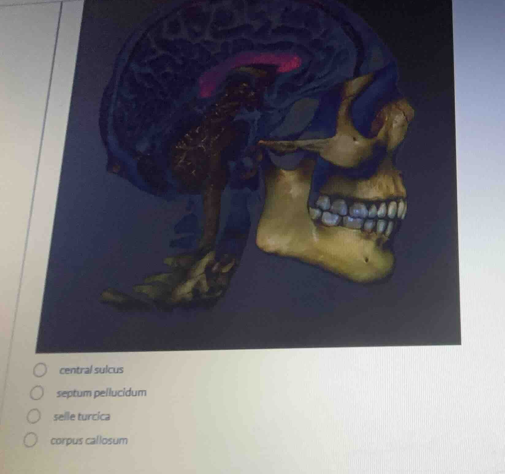 central sulcus septum pellucidum selle turcica corpus callosum