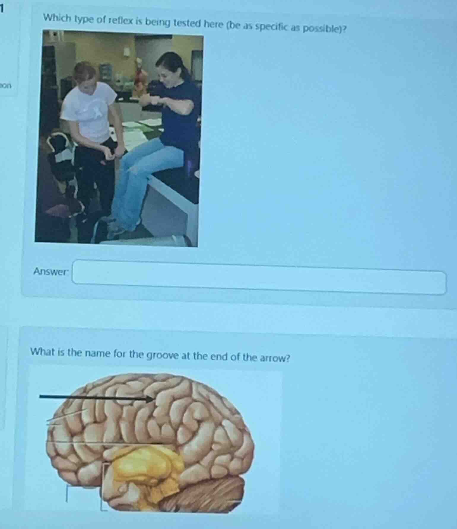 which type of reflex is being tested here (be as specific as possible)?…